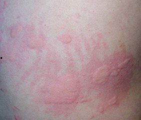 湿疹可以吃生瓜,湿疹患者适宜生瓜养生食谱